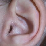 Crusty Ears Causes, Symptoms, with Discharge and Treatment