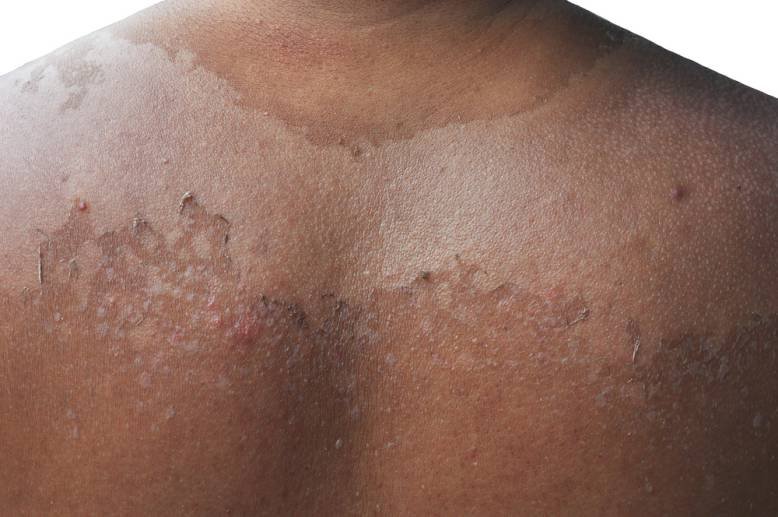 Sunburn Skin Peeling Causes, Lotions, Creams, Remedies and Prevention