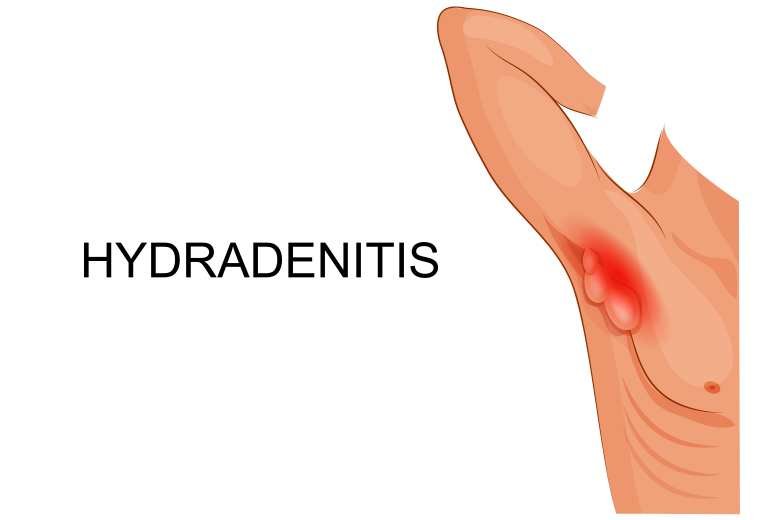 Armpit rash due to Hidradenitis suppurativa