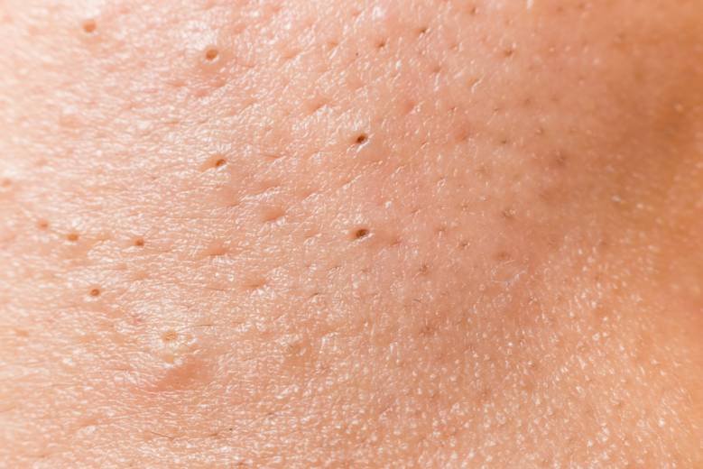 Blackheads on Inner Thighs Meaning, Causes, Symptoms and Treatments
