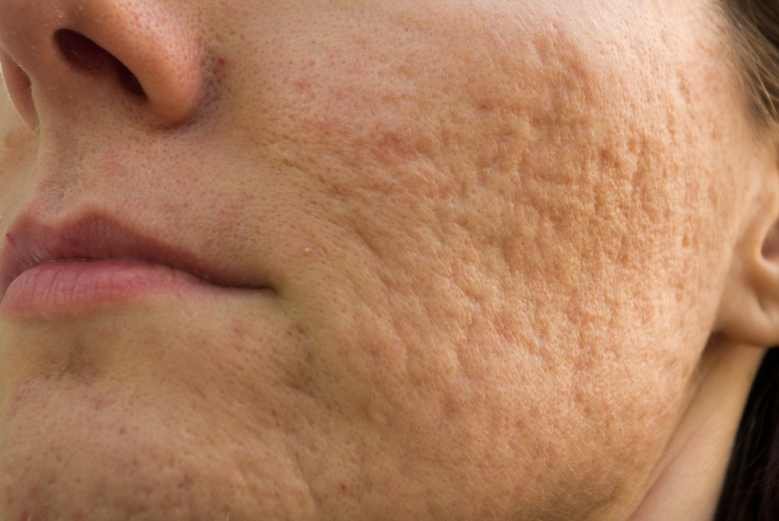 Depressed acne scars on cheeks