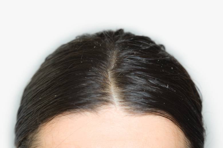 Greasy hair meaning, tips, greasy scalp, best products and shampoos