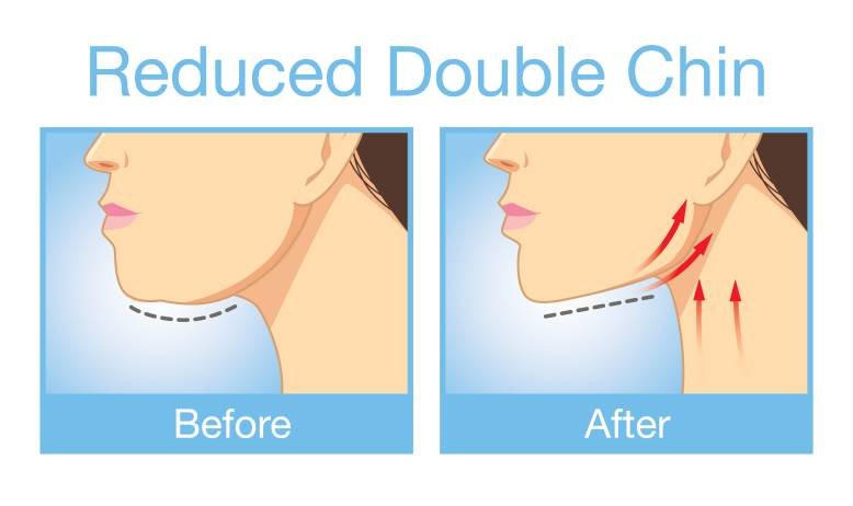 Exercises to reduce neck fats and double chin