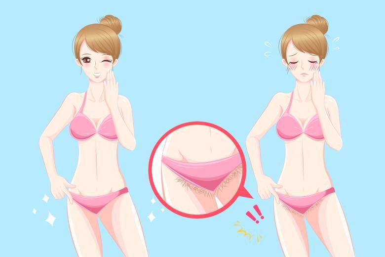 Pubic hair removal can cause ingrown hair