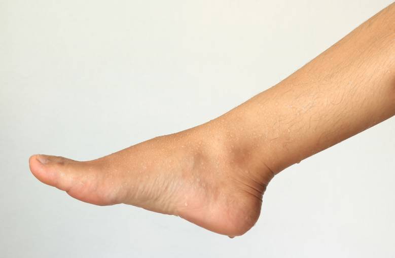 Sweaty Feet Causes, Treatments, Remedies, Best Socks and Shoes to Wear