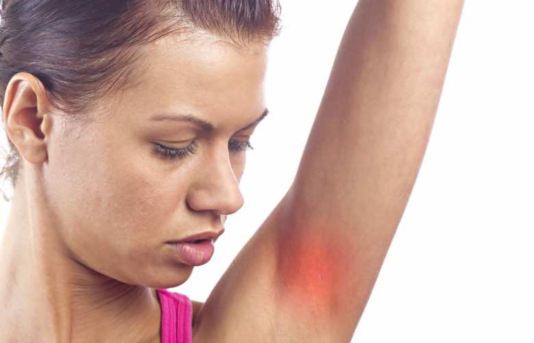 Armpit Rash Causes, Painful Red Itchy and Treatments