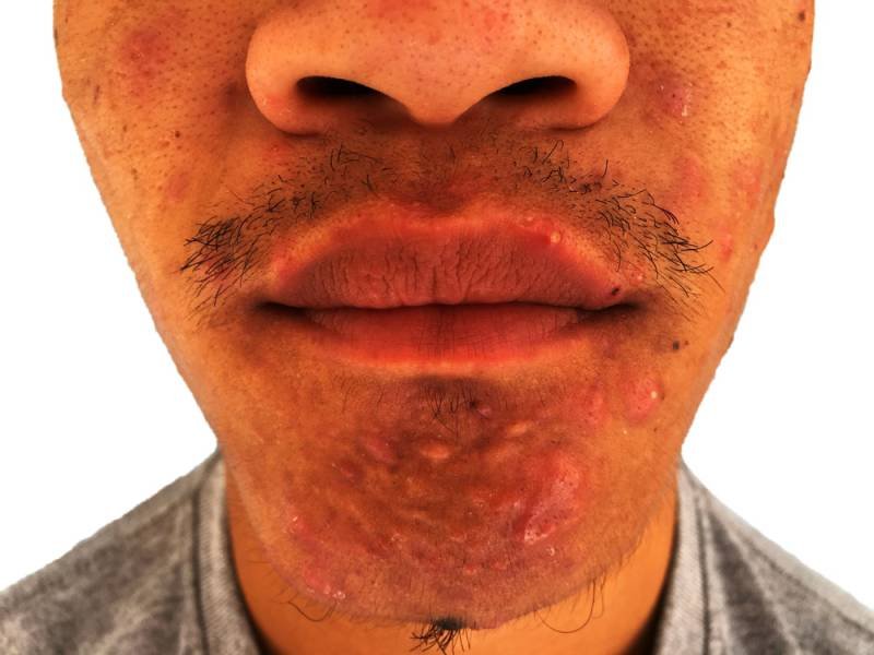 Cystic acne on chin - inflammatory