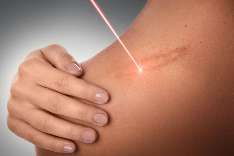 Laser dark scar removal