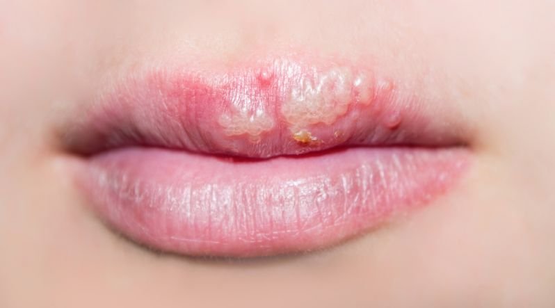 Oral herpes on the mouth can cause white bumps like blisters