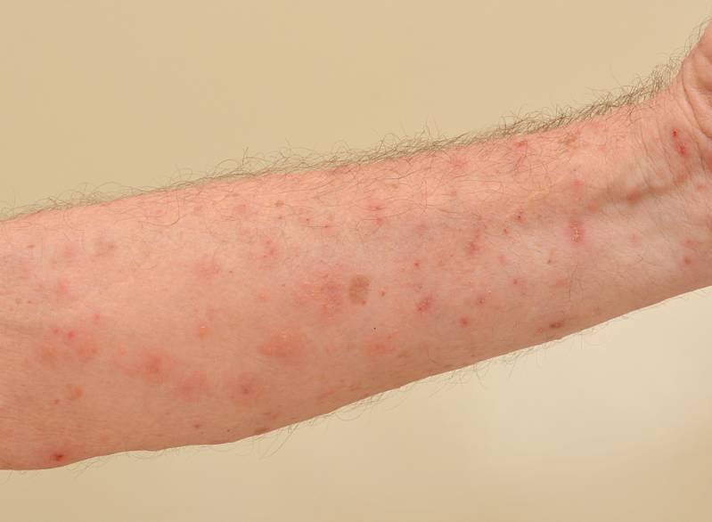Pimples and bumps on arms causes, treatments