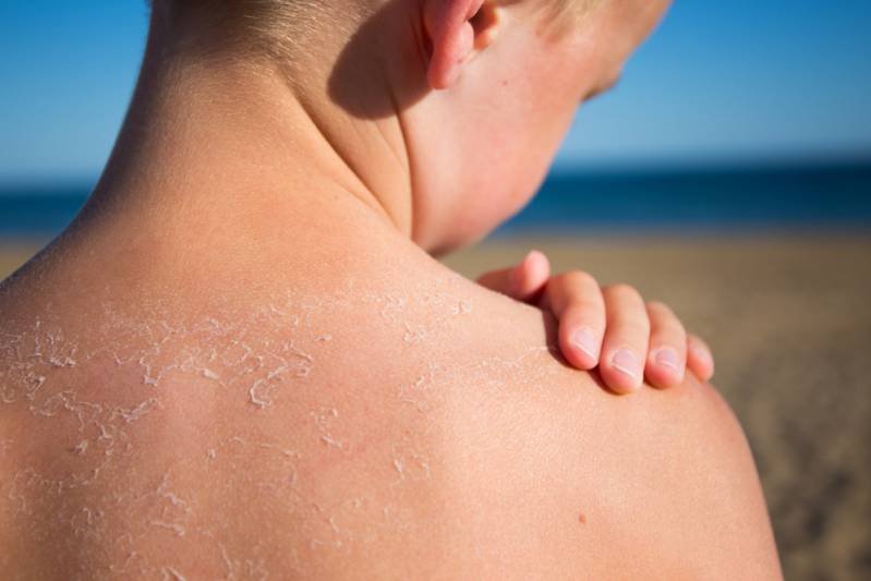 Sunburn Healing Time for Mild to Severe with Pain, Swelling, Peeling, Rash, Blisters and Redness