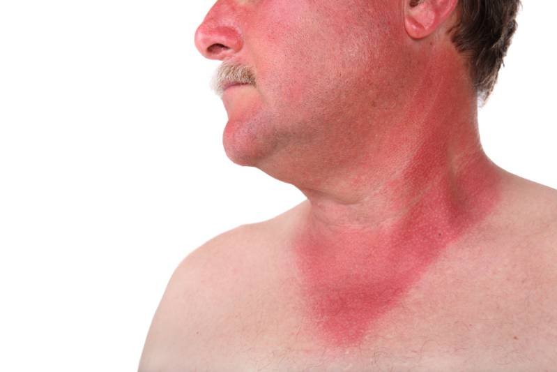 Redness due to sunburn healing duration