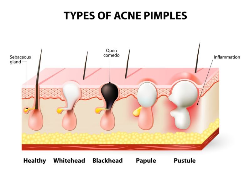 Whiteheads Acne Types 