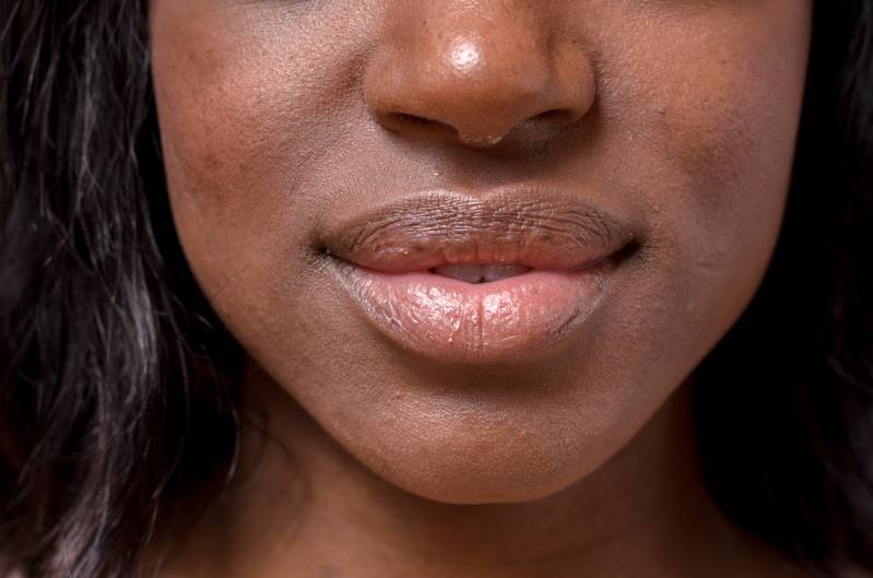 Dark Lips Causes, Remedies & Creams to Lighten Them