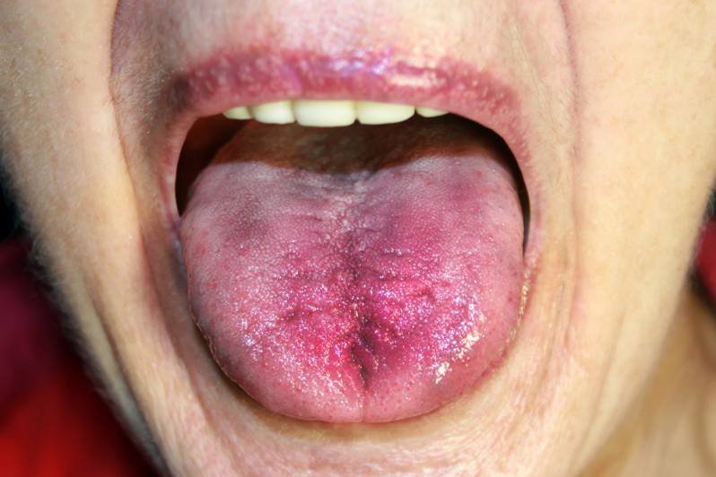 Discolored tongue