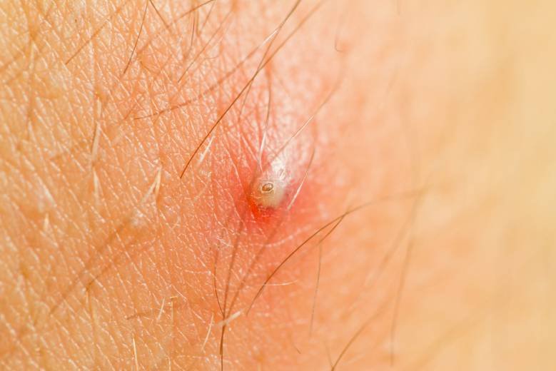 Pus filled ingrown hair bump