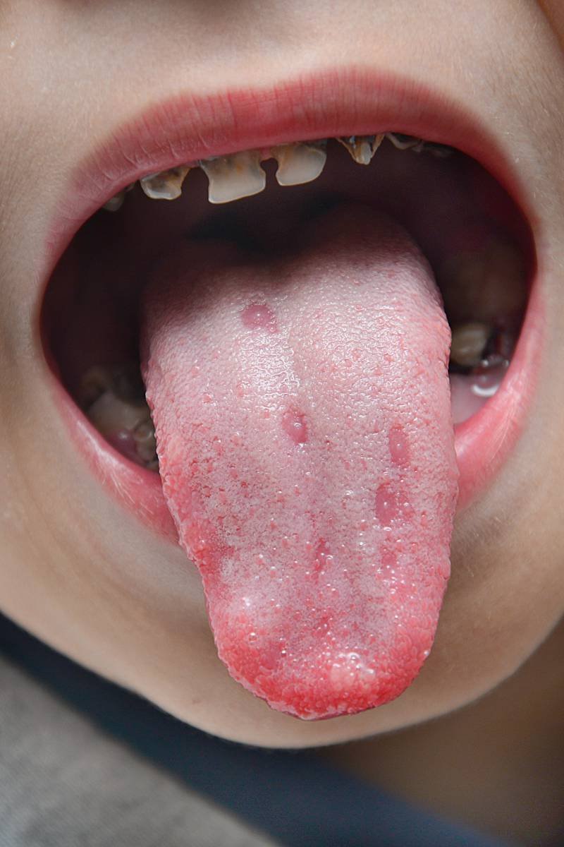 Tongue and mouth ulcers