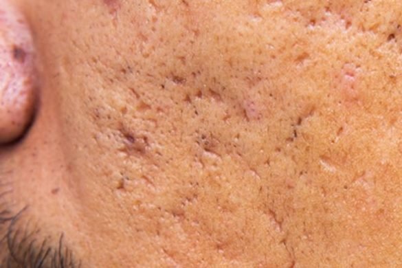 10 Causes Of Pimples On Inner Thighs