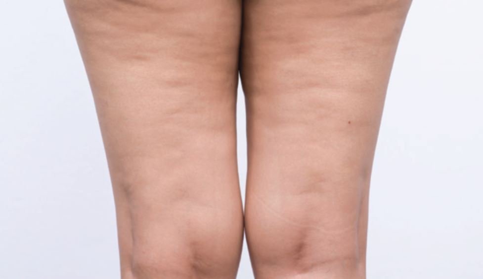 Cellulite on thighs - facts and treatment s