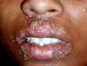 Cold sores on lips