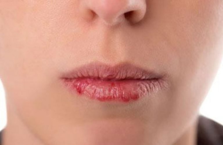 Dry Peeling Lips During Pregnancy Causes & Cures - Best Daily Guide