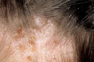 Head lice on scalp bumps