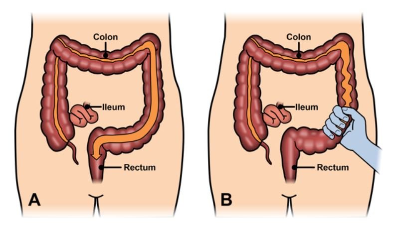 Irritable bowel syndrome