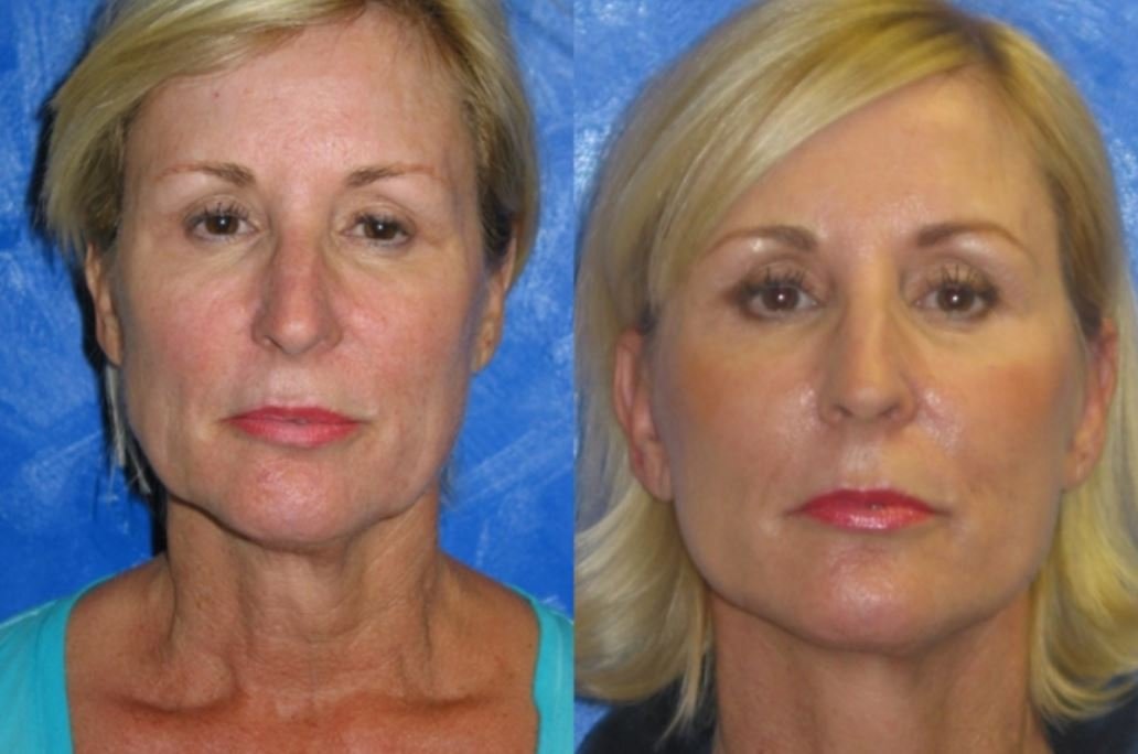 Loose skin on neck before and after - Image courtesy of Fisher Cosmetic Facial Surgery