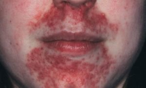 Perioral dermatitis on lips spread to nose and chin areas