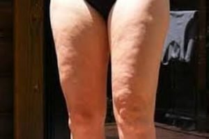 Severe cellulite on legs