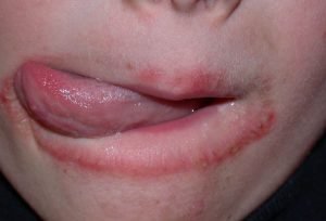 Upper and lower lip rash causes - Lickers dermatitis
