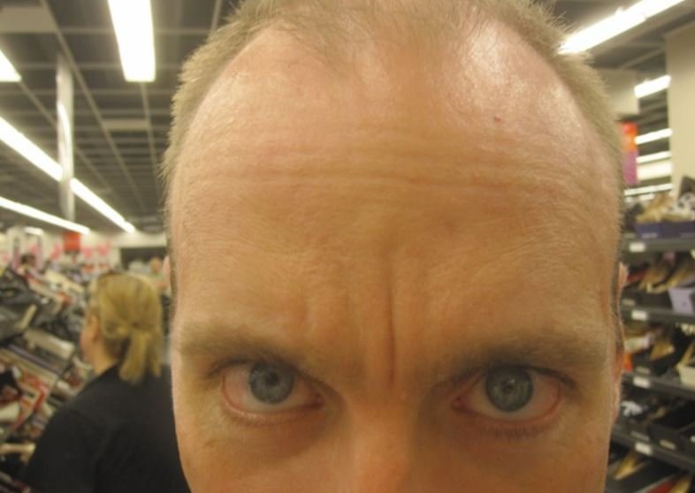 Vertical dent on forehead - Vertical and horizontal wrinkles