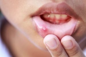 Blisters inside of lips - on lower inner lip 