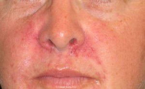 Eczema on nose
