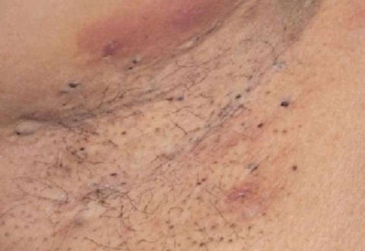 Causes and How Rid of Blackheads on Underarms