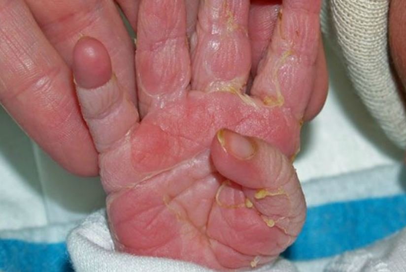 Causes and How to Treat Baby Skin Peeling