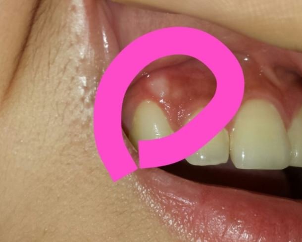 Pimple-like bumps on gums