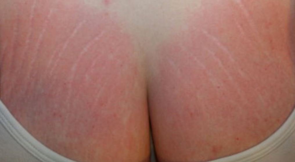 Stretch marks on breasts
