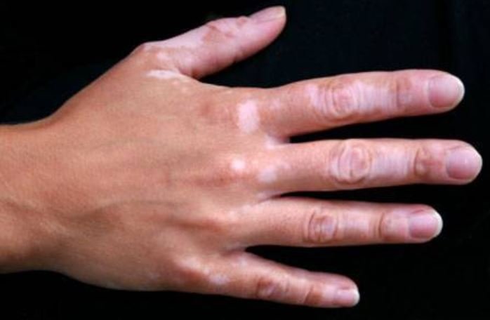 White patches on hands - Vitiligo