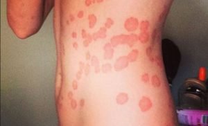 Large red spots or patches on skin - psoriasis