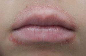 Lip licking eczema